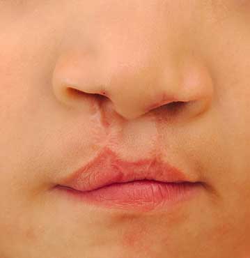 Calgary Cleft Lip and Palate Treatments