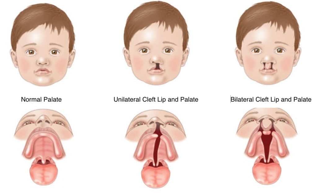 Cleft Lip/Palate & Craniofacial Anomalies in NE Calgary