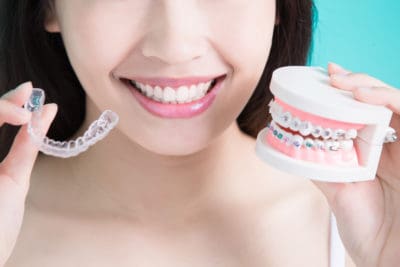 Braces vs Clear Aligners