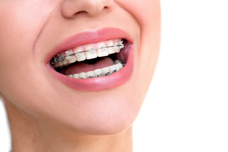 The Reasons and Options For Braces