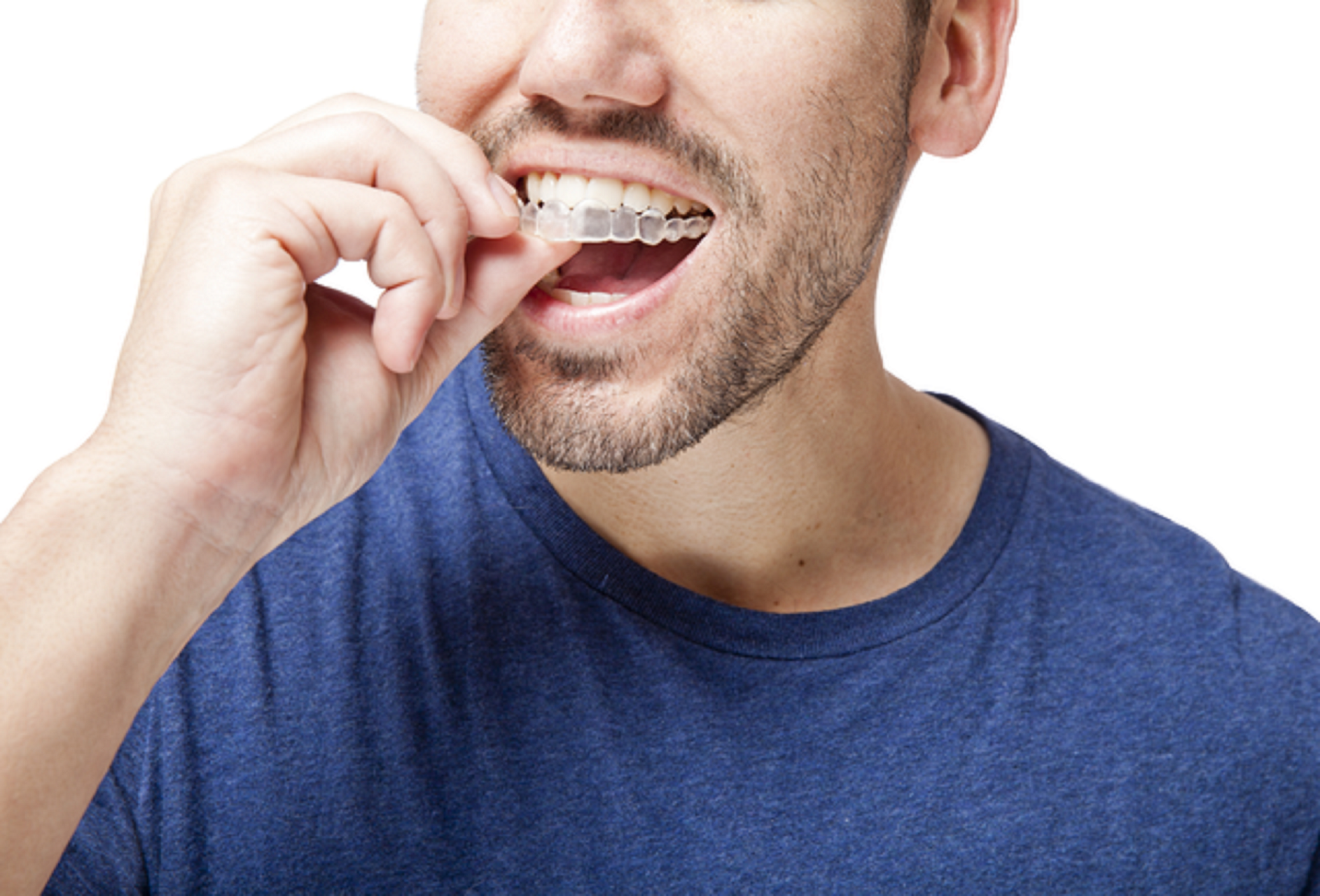 how does invisalign for teens differ from invisalign for adults